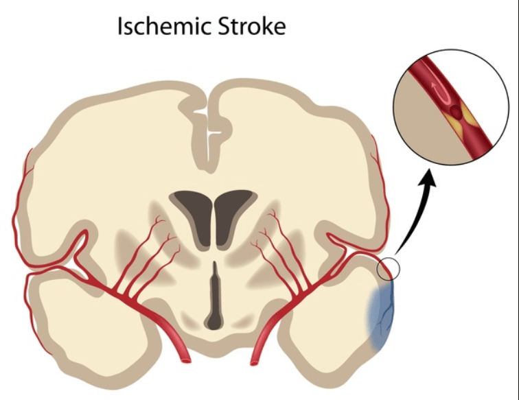Заболевание CADASIL увеличивает риск инсульта. Фото.