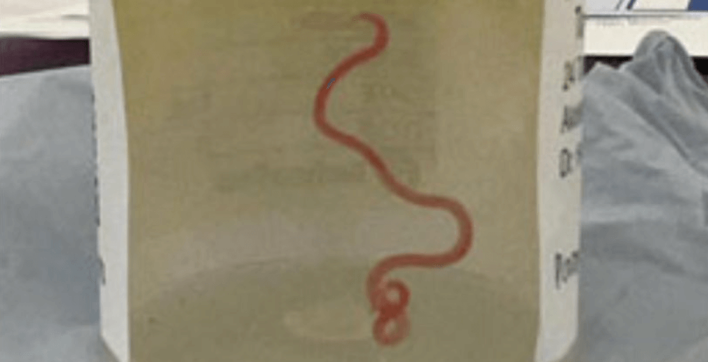 Опасность зоонозных заболеваний. Ophidascaris robertsi попал в организм женщины через листовой овощ. Опасность зоонозных заболеваний. Ophidascaris robertsi попал в организм женщины через листовой овощ. Фото.