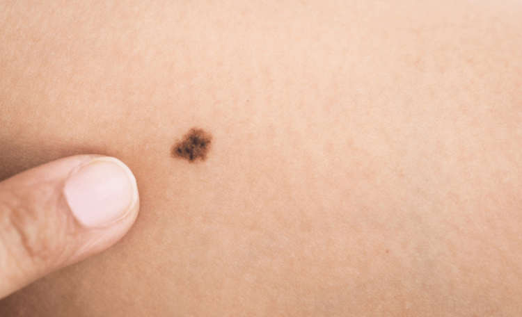 Сколько времени требуется коже, чтобы появился загар. Загар увеличивает риск возникновения рака кожи. Фото.