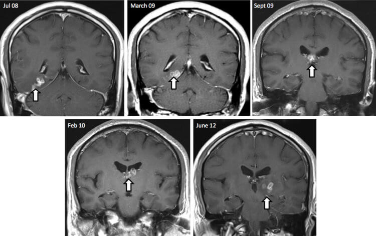 Ленточные черви. Результаты МРТ-сканирования показали, что червь проник из одной части мозга пациента в другую. Фото.