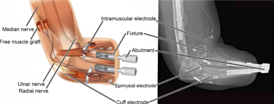 Уникальный бионический протез. Иллюстрация и рентгеновский снимок соединения культи с протезом. Фото.