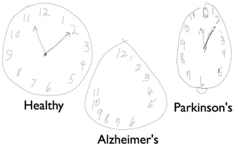 Тест на деменцию. На изображении показаны нарисованные часы здорового человека и людей с болезнями Альцгеймера и Паркинсона. Фото.