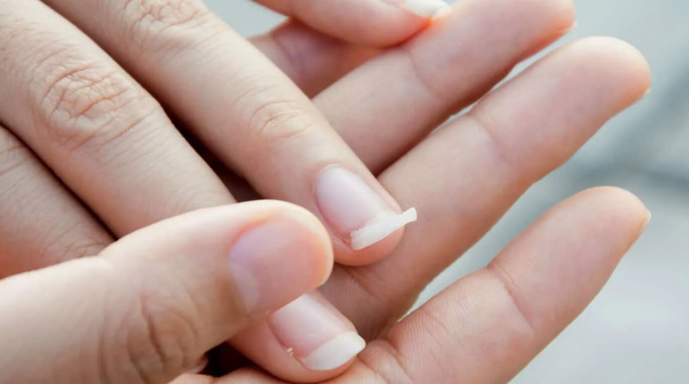 Почему ногти тонкие и ломкие. Зачастую ногти становятся слабыми из-за недостатка витаминов и минералов. Фото.
