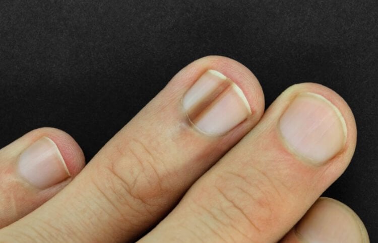 Что означают темные полосы на ногтях. Черная полоса на ногте человека. Фото.