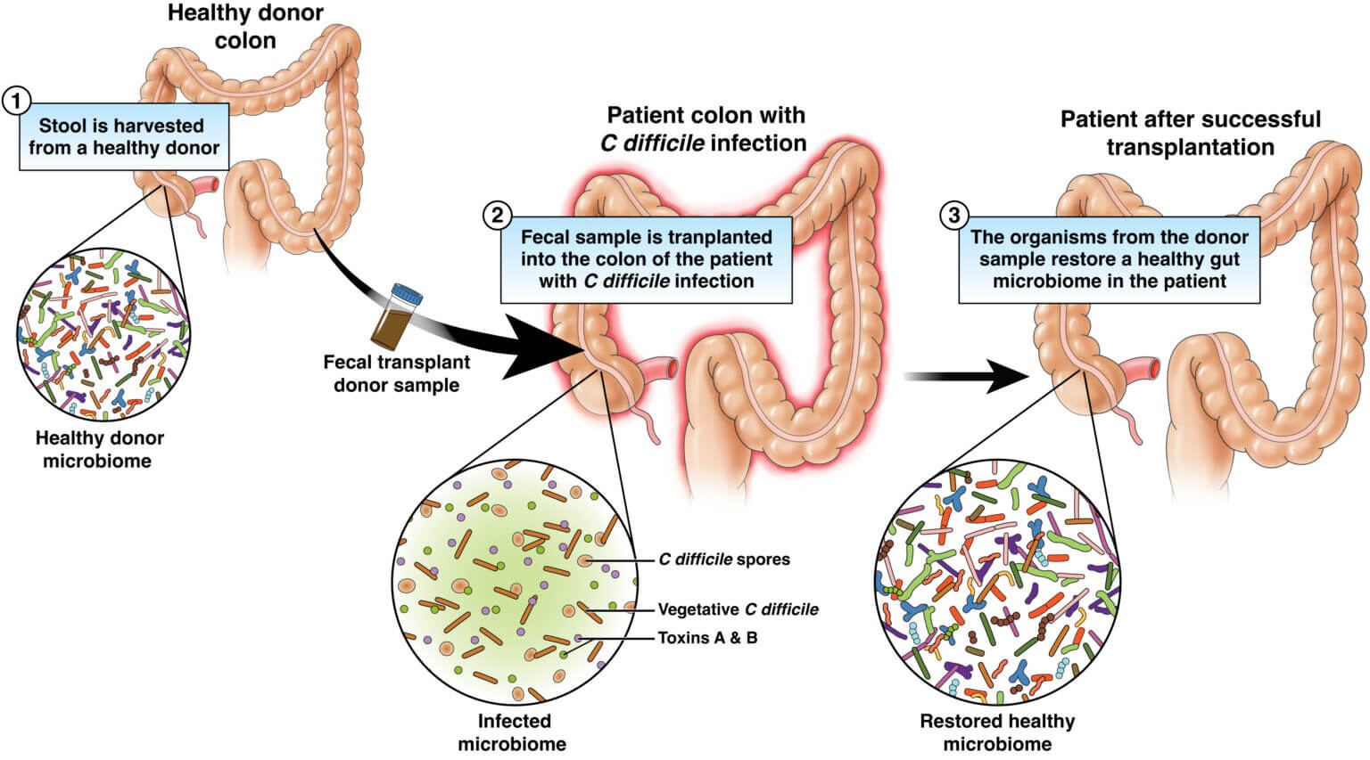 Эффективность. Микробиом пациента с бактериальной инфекции до и после процедуры ТФМ. Фото.