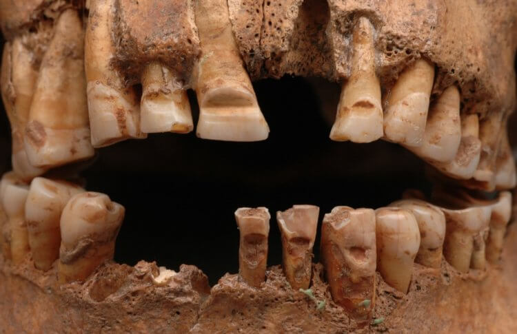 Стоматология древних времен. Викинги очень старались лечить зубы, и достигали некоторых успехов. Фото.