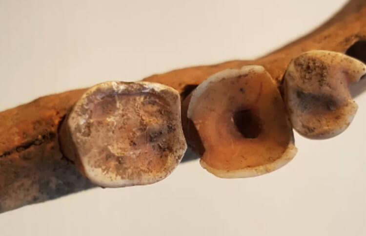 Какими были зубы викингов. В зубах викингов были найдены кариозные отверстия. Фото.