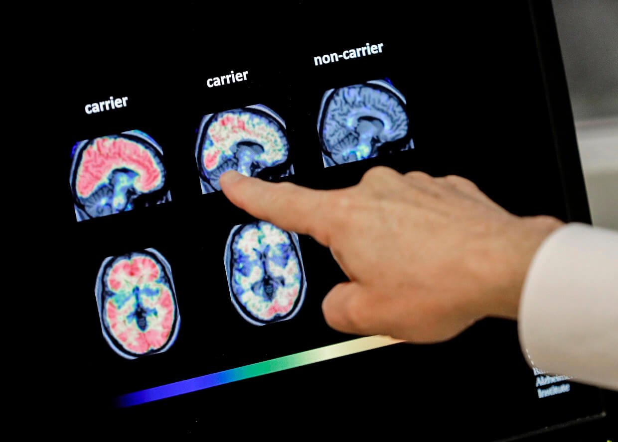 Новые методы лечения болезни Альцгеймера. Болезнь Альцгеймера — одна из самых страшных заболеваний в мире, против которой у ученых все еще нет эффективного лекарства. Фото.