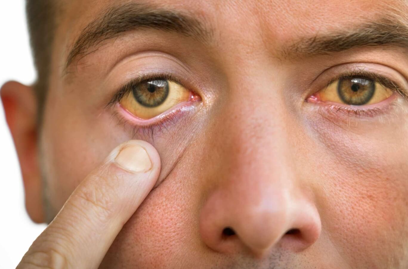 Желтые глаза после алкоголя. Из-за алкоголя, кожа и глаза могут стать желтыми. Изображение: Verywellhealth. Фото.
