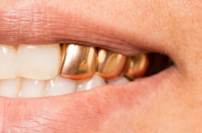 Почему во времена СССР были популярны золотые зубы. Фото.