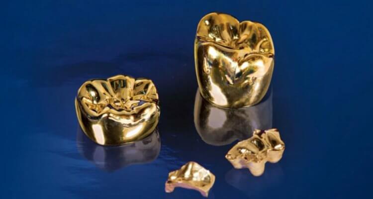 Минусы золотых зубов. Стоимость золотых зубов зависит от клиники. Фото.