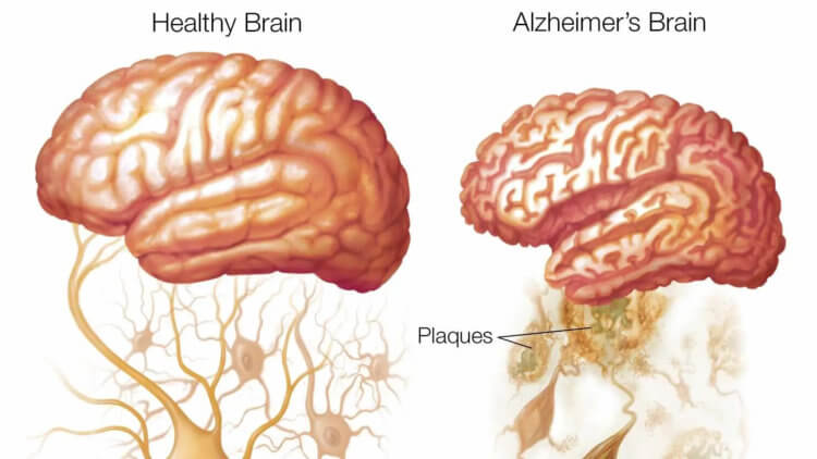 Прионы и бета-амилоиды. Мозг здоровго человека и человека с болезнью Альцгеймера. Фото.