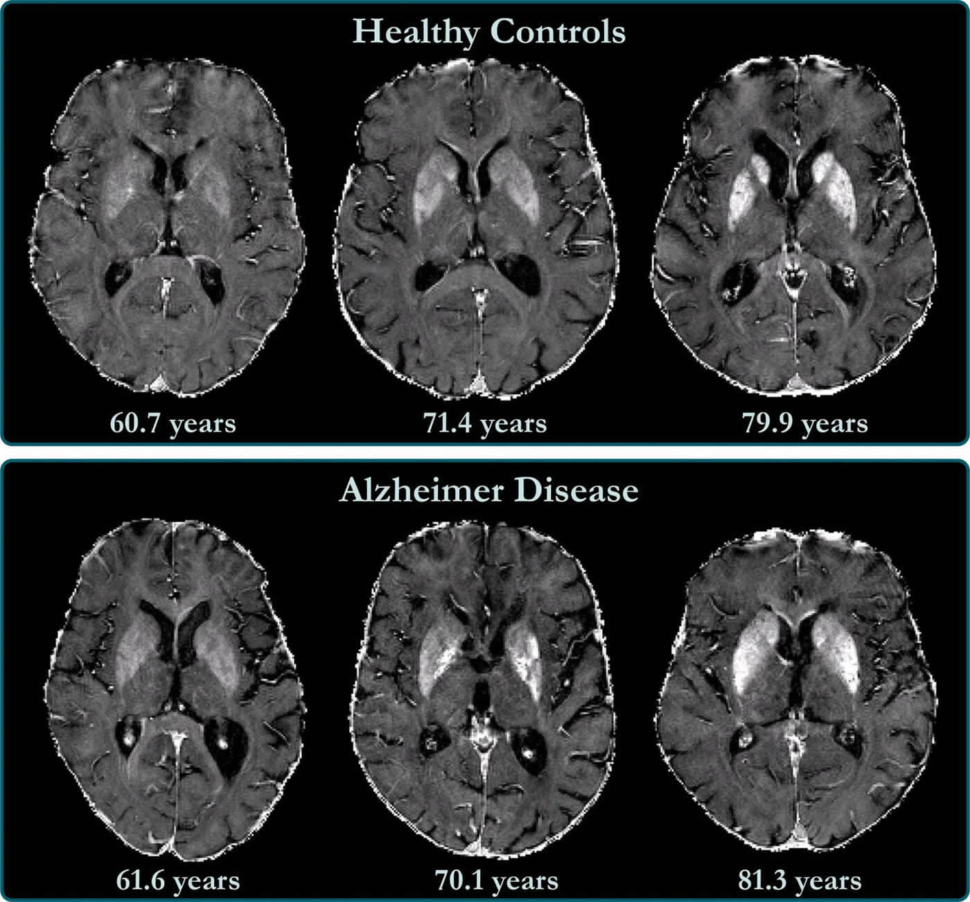 Причины, признаки и симптомы болезни Альцгеймера. Как выглядит здоровый мозг и мозг пациента с болезнью Альцгеймера. Фото.