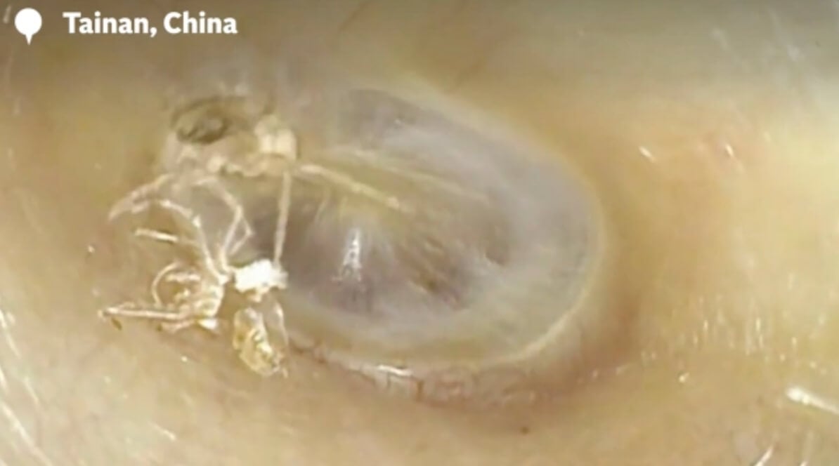 В ухо жительницы Тайваня заполз паук. Паук внутри уха жительницы Тайваня. Фото.