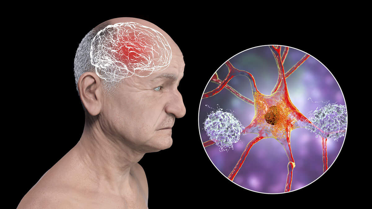 Можно ли заразиться болезнью Альцгеймера? Болезнь Альцгеймера все чаще связывают с прионными нейродегенеративными заболевания. Фото.