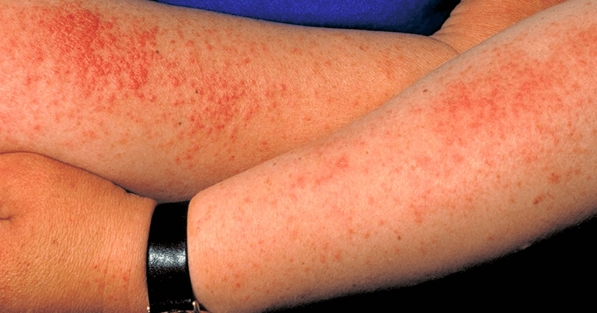 Аллергия на солнце — “вампирская болезнь”. При фотодермии на коже возникает сыпь. kaktus.media. Фото.