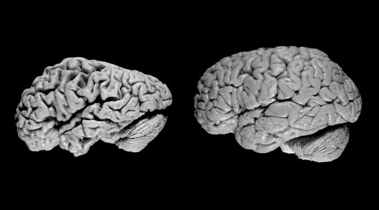 Minska risken att utveckla demens. Hjärnan hos en person med demens (vänster) och en frisk person (höger). Bild: lninstitute.org. Foto.