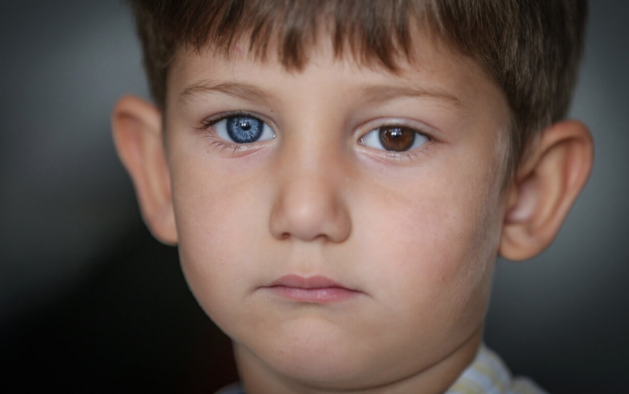Мутация разного цвета глаз. Гетерохромия у ребенка. Фото.