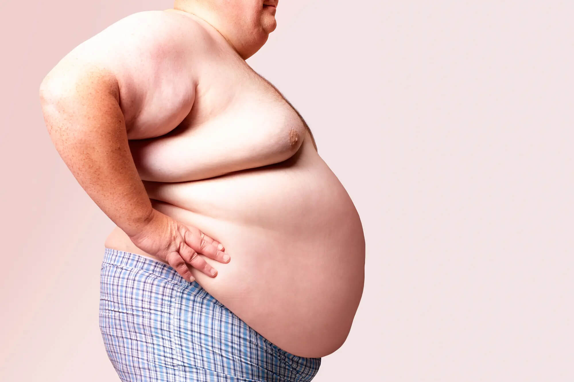 Ожирение – серьезная проблема. Ожирение – одна из причин избыточной смертности в мире. Фото.