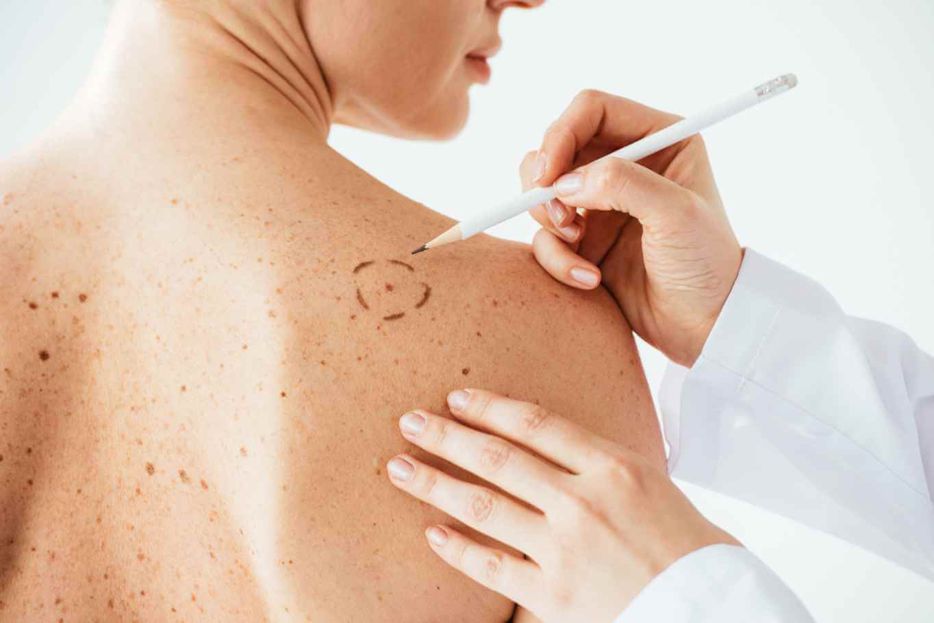 Какая эффективность вакцины от рака кожи. В ближайшее время медицина сможет более эффективно бороться с раком. Фото.
