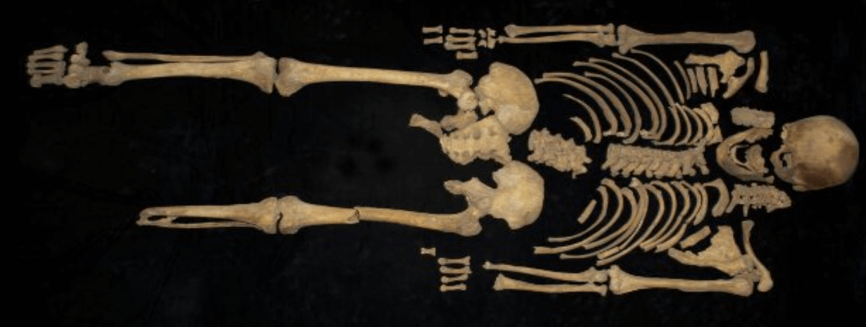 Археологическая находка на древнем кладбище. Один из скелетов возрастом 2500 лет с ампутированной ногой. Источник фото: nplus1.ru. Фото.