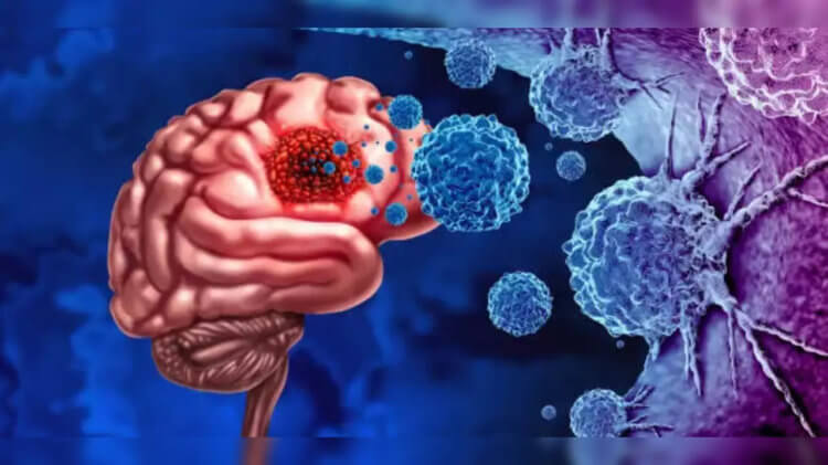 Gliom och glioblastom. Gliom är primära tumörer som bildas i hjärnans parenkym. Bild: static.tnn.in. Foto.