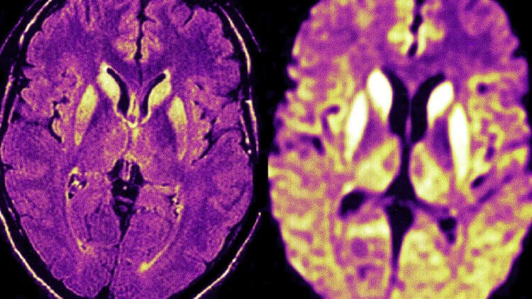 The most terrible disease in the world. The brain of a patient infected with Creutzfield-Jakob disease (mad cow disease). Image: medpagetoday.net. Photo.