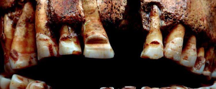 What were the Viking teeth like? A Viking skull with marks on the teeth. Photo source: sciencealert.com. Photo.