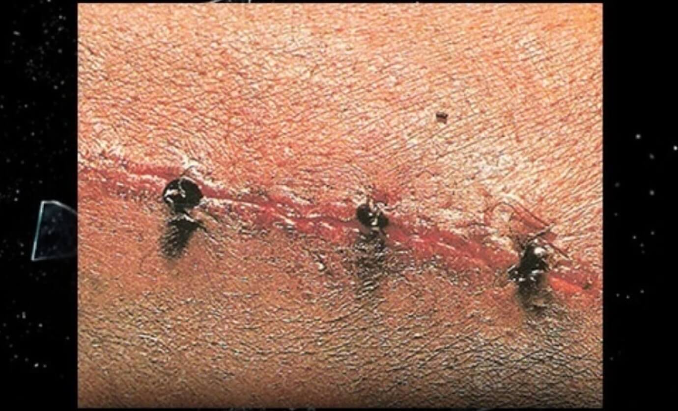 Муравьи для зашивания ран. Зашитая муравьями рана на руке. Источник изображения: antclub.org. Фото.