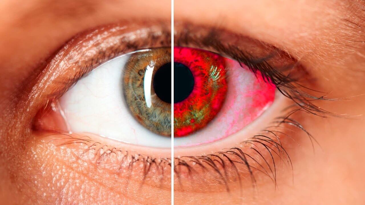 Важна функция моргания. Пересыхание глаз может привести к воспалению и даже слепоте. Источник фото: masterok.livejournal.com. Фото.