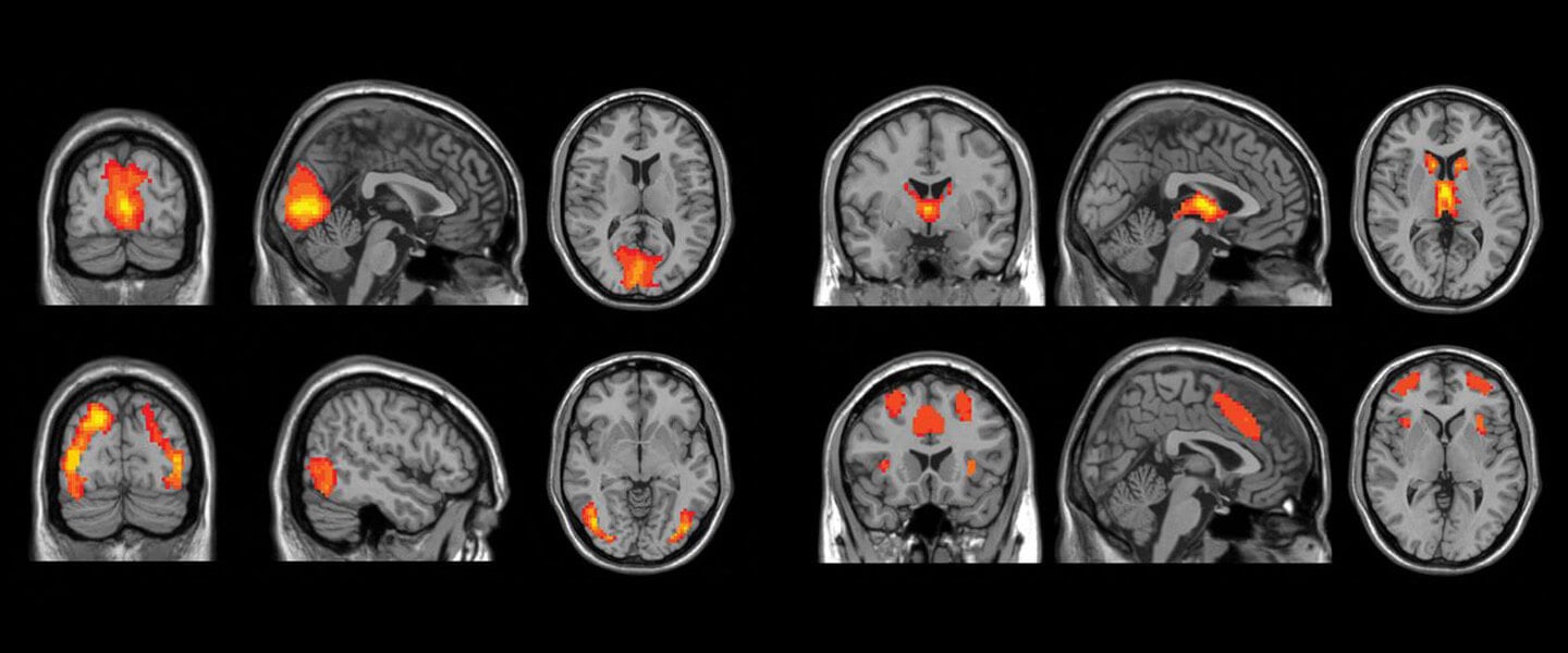 Какой бывает депрессия? Магнитно-резонансная томография (МРТ) позволяет увидеть мозг человека, страдающего от депрессии. Изображение: bbrfoundation.org. Фото.