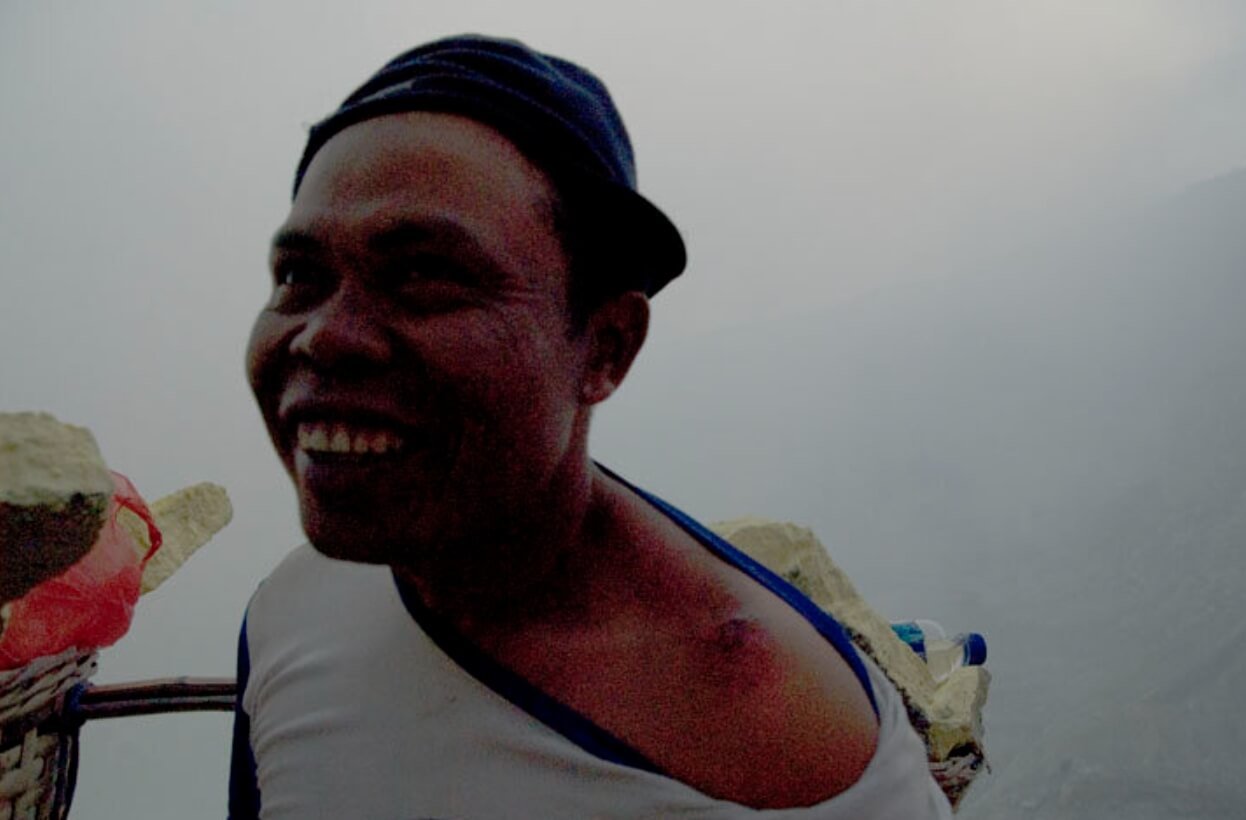 Добыча серы на вулкане Иджен. Рана на плече одного из работников. Источник: yalejournal.org. Фото.