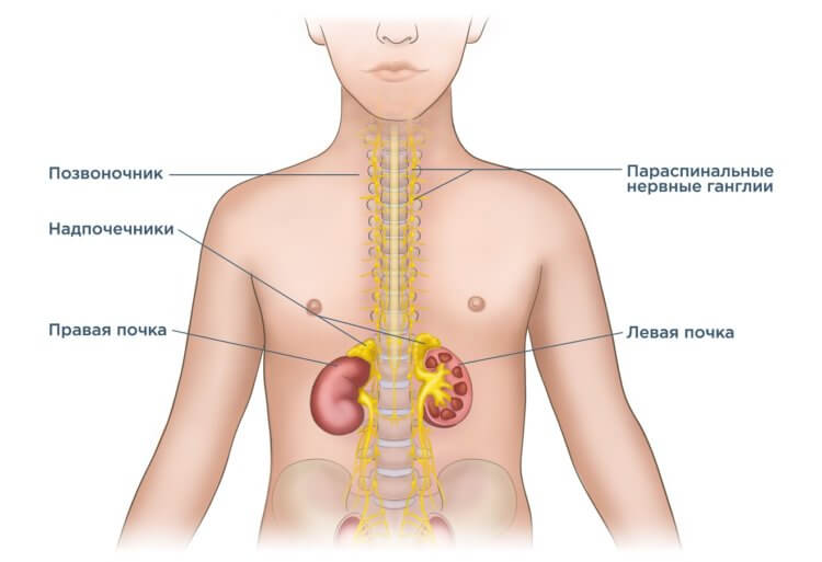 Даниэльза — лекарство против нейробластомы. Нейробластома может возникнуть в разных частях тела. Источник фото: neuroblastoma.help. Фото.