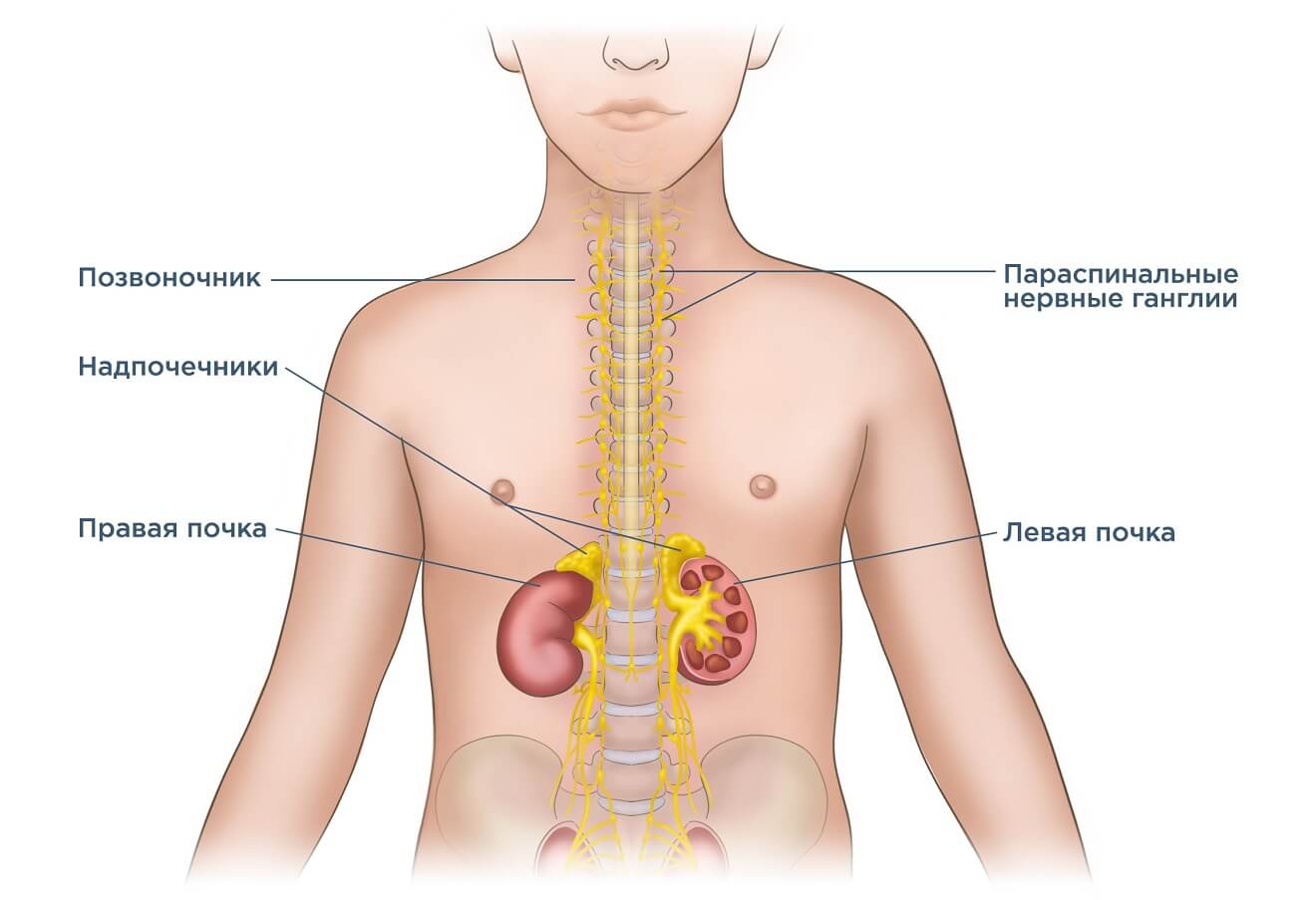 Даниэльза — лекарство против нейробластомы. Нейробластома может возникнуть в разных частях тела. Источник фото: neuroblastoma.help. Фото.