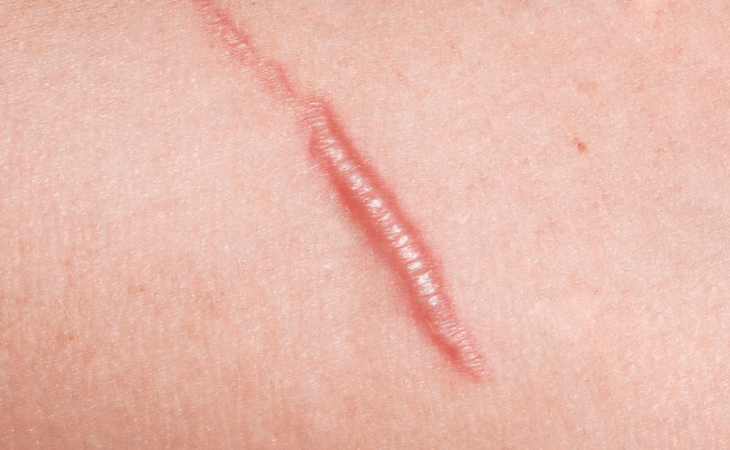 Почему на коже возникают шрамы. Гипертрофический рубец выпирает над кожей. Источник фото: zentromed.com. Фото.