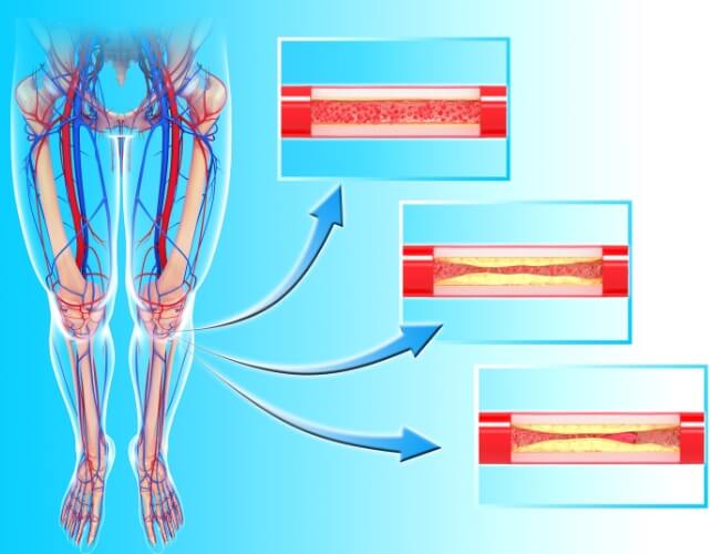 Боль при ходьбе. Иллюстрация сужения периферической артерии из-за холестериновых бляшек. Изображение: sciencealert.com. Фото.