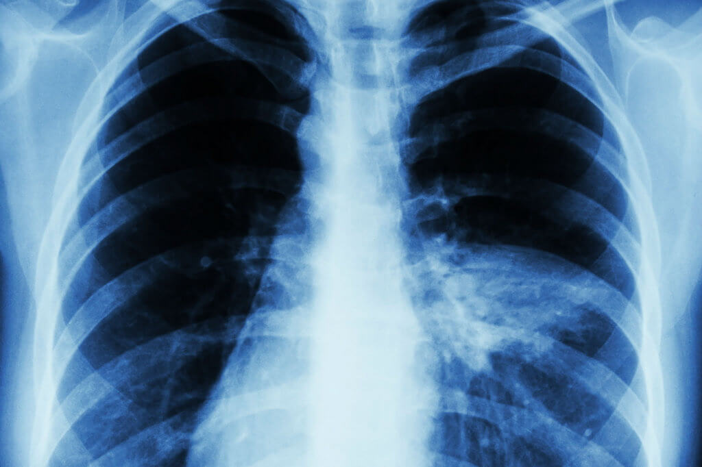 Что такое двусторонняя пневмония. При двусторонней пневмонии поражены оба легких. Источник: gkbyudina.ru. Фото.