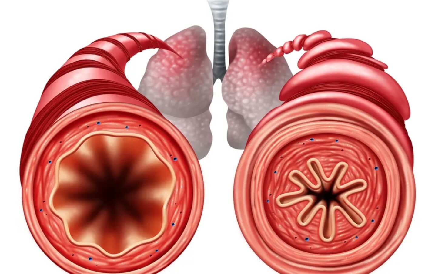 Дыхательные пути до и после приступа астмы. Источник изображения: Live Science. Фото.