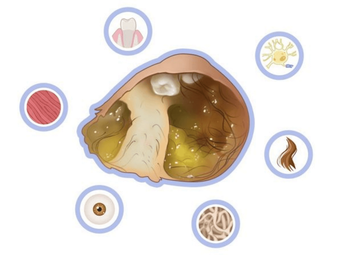 Близнец-паразит, который растёт как опухоль. Зрелая тератома представляет собой кисту, которая содержит волосы, зубы, кожу, кости, мышцы. Источник изображения: probolezny.ru. Фото.
