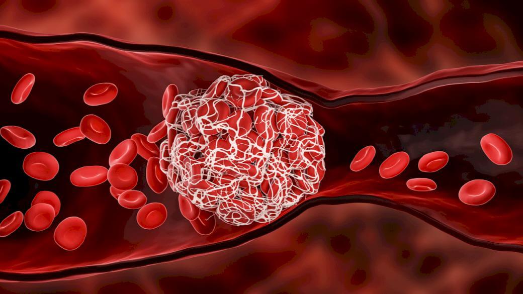 Тромбы играют ключевую роль в возникновении инсультов. Источник: doc-tv.ru. Фото.