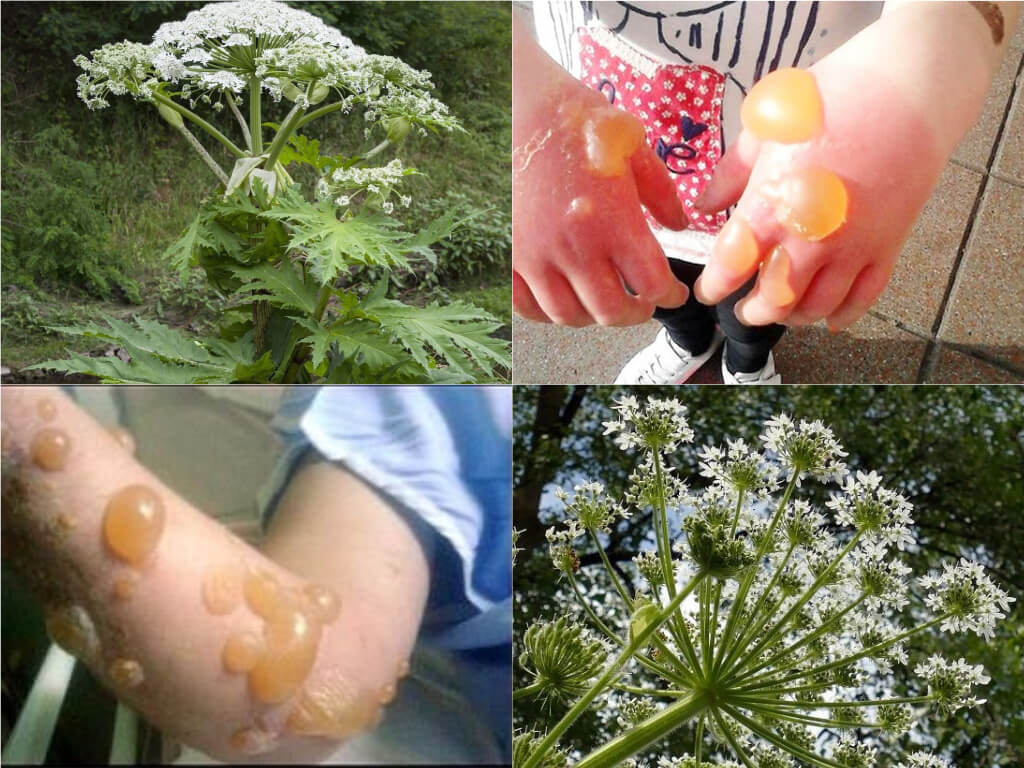 Чем опасен борщевик: ожоги и другие последствия для здоровья. Сок борщевика содержит фуранокумарины, вызывающие фотоконтактный дерматит/ожоги; симптомы нередко проявляются спустя часы–сутки после контакта и инсоляции. Источник изображения: mixyfotos.ru. Фото.