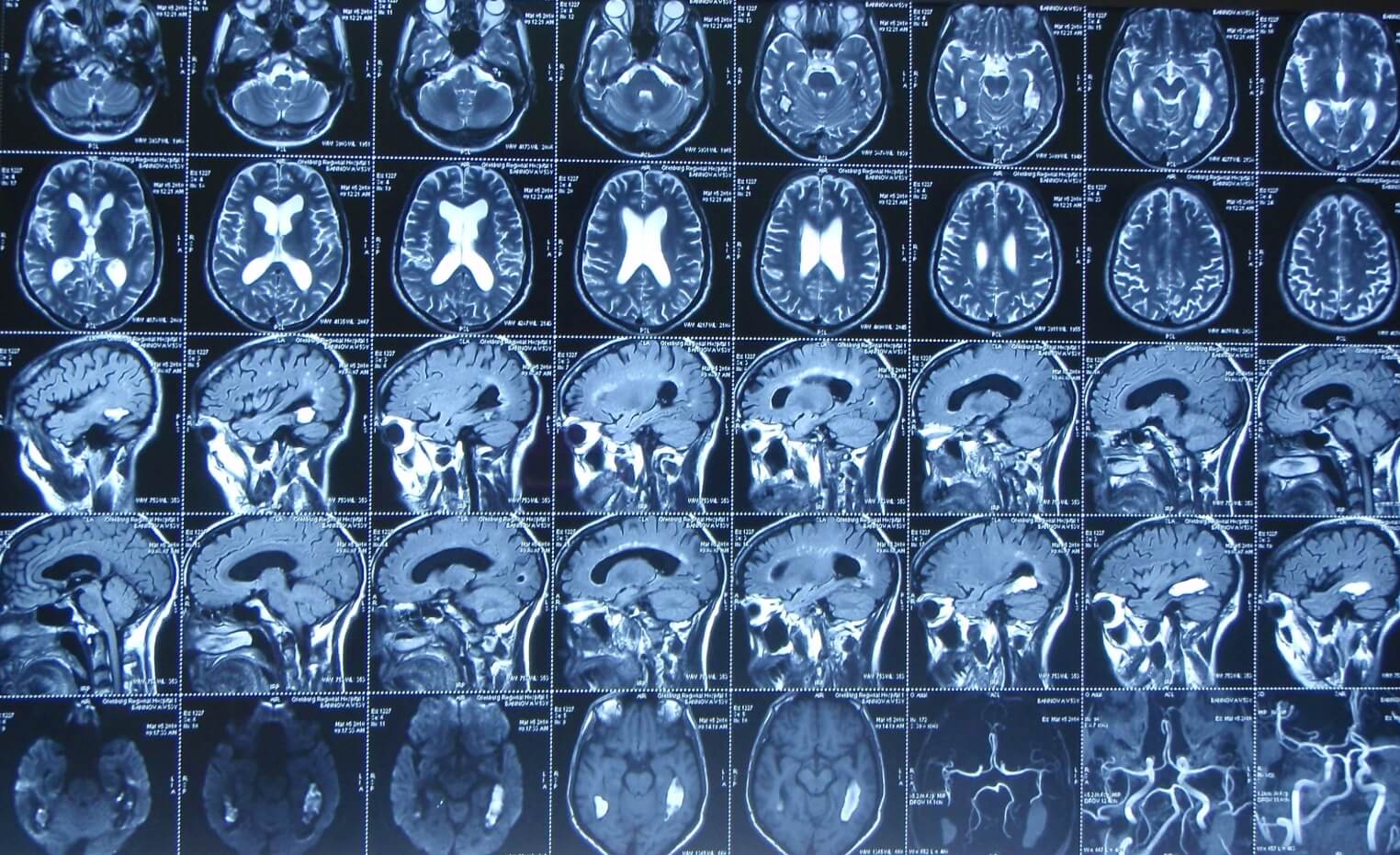 Электроника телефона создает помехи, из-за которых снимки МРТ становятся бесполезными. Фото.