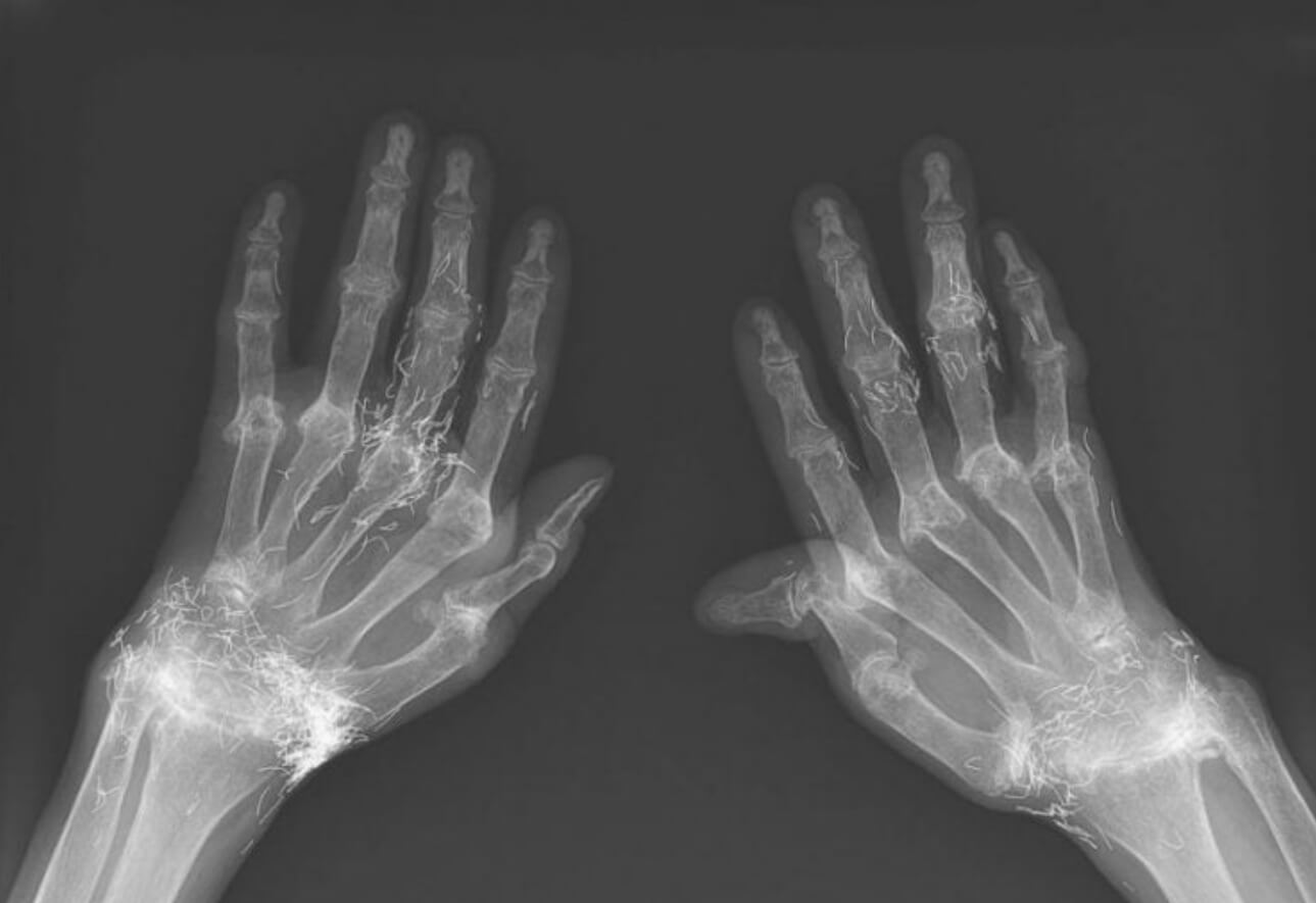 Что такое иглоукалывание золотыми нитями. Золотые нити были обнаружены даже в руках пациентки. Источник изображения: The New England Journal of Medicine. Фото.