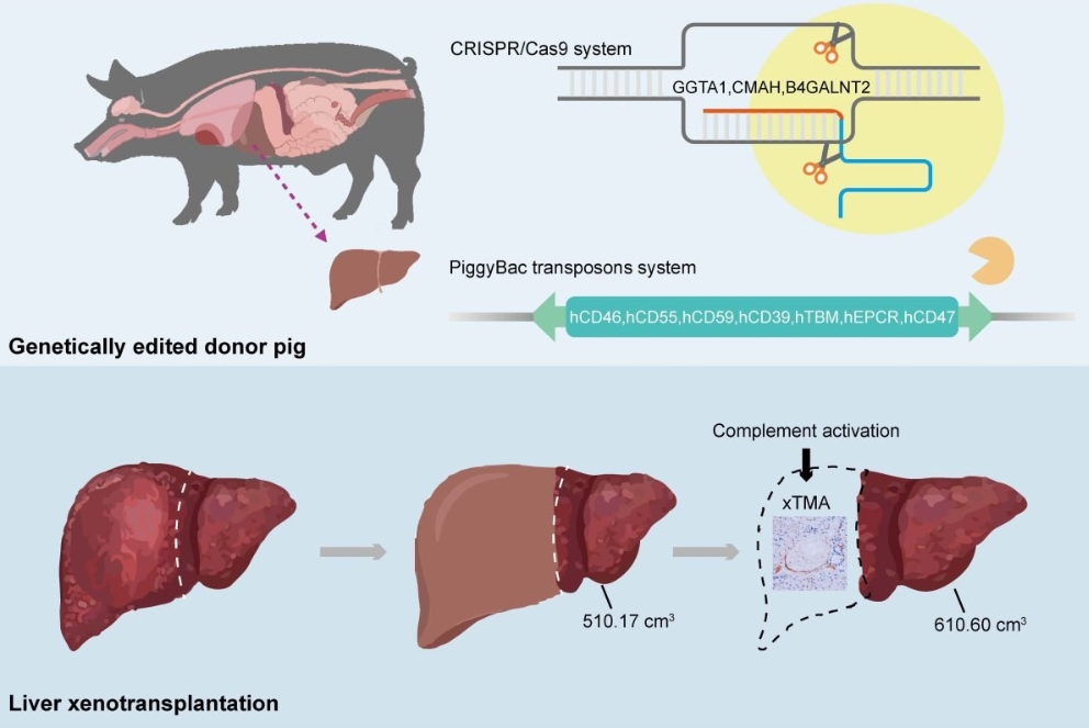 Ученые заменили пораженную цирозом часть печени человека свиным органом после его генной модификации. Фото.