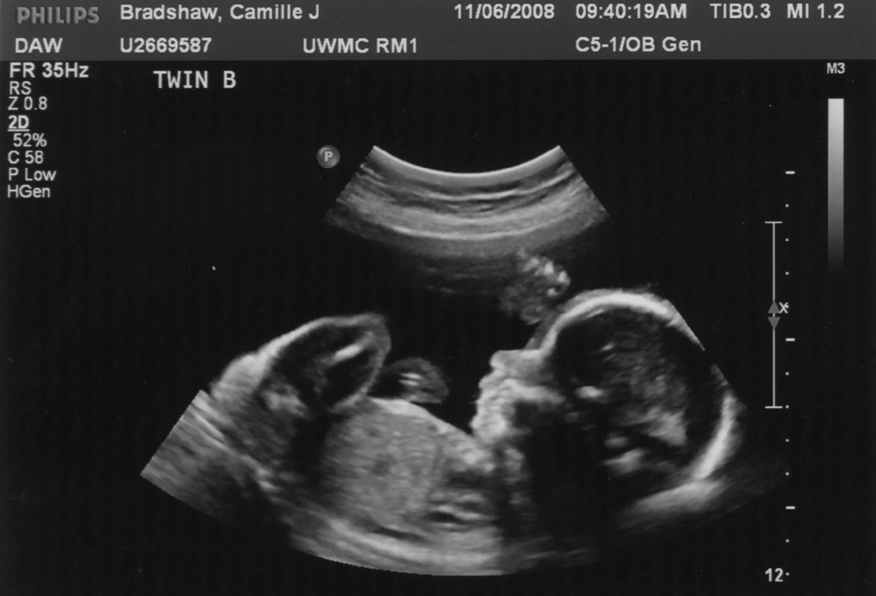 Иногда УЗИ ошибаются с размером ребенка. Источник изображения: dishcuss.com. Фото.