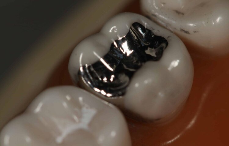 Амальгама в стоматологии. Амальгамовая пломба во рту человека. Источник фотографии: reddit.com. Амальгама в стоматологии. Амальгамовая пломба во рту человека. Источник фотографии: reddit.com. Фото.