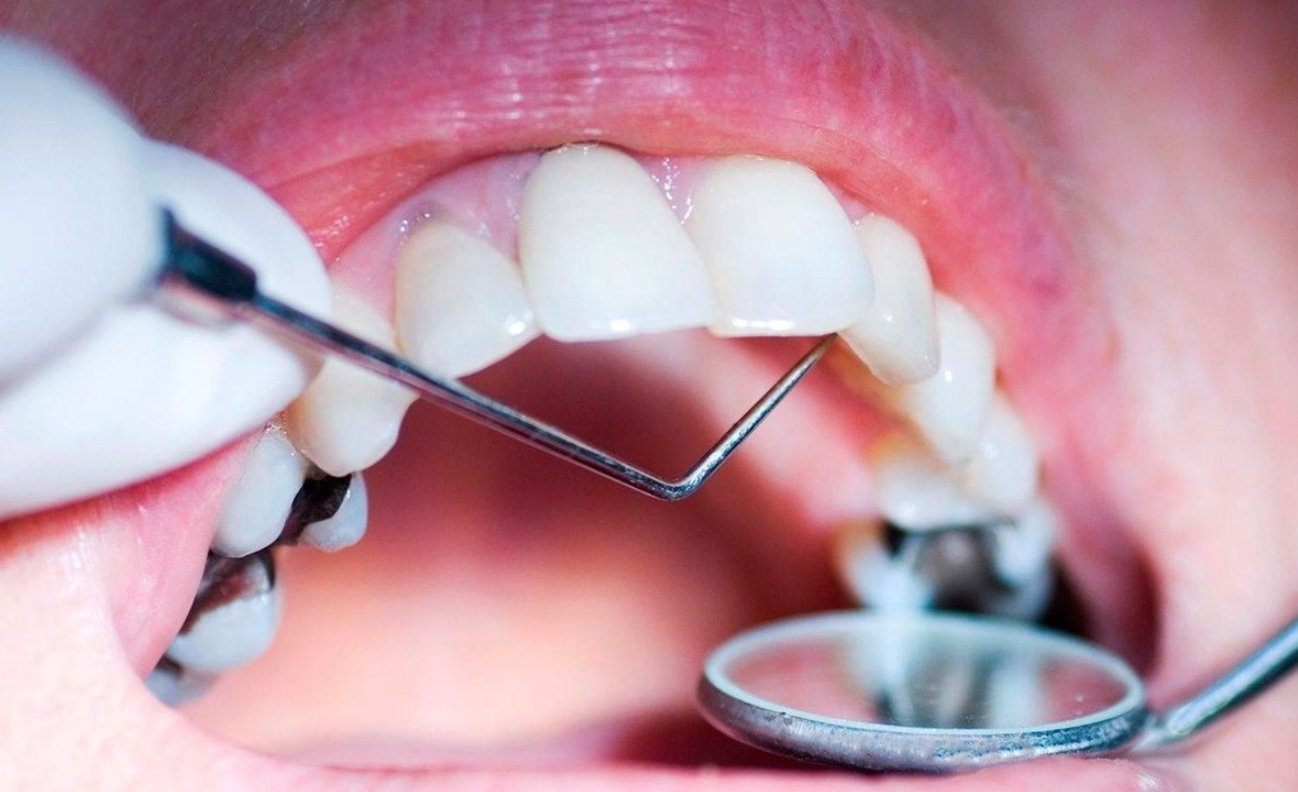 Современные пломбы практически незаметны на зубах. Источник фотографии: yar.mk.ru. Фото.