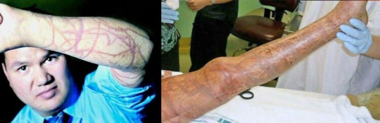 Что делать при ожоге кубомедузы: инструкция первой помощи. Следы ожогов медуз. Источники изображений: medok-spb.ru, abc.net.au. Фото.