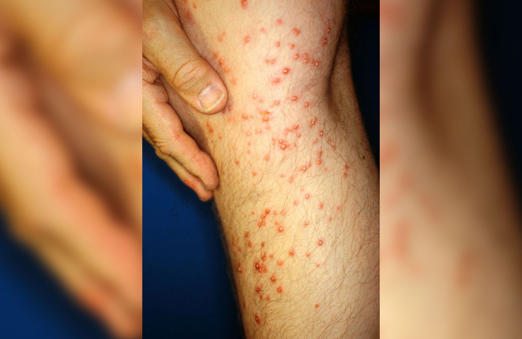 Следы укусов огненных муравьев. Источник фотографии: wikipedia.org. Фото.