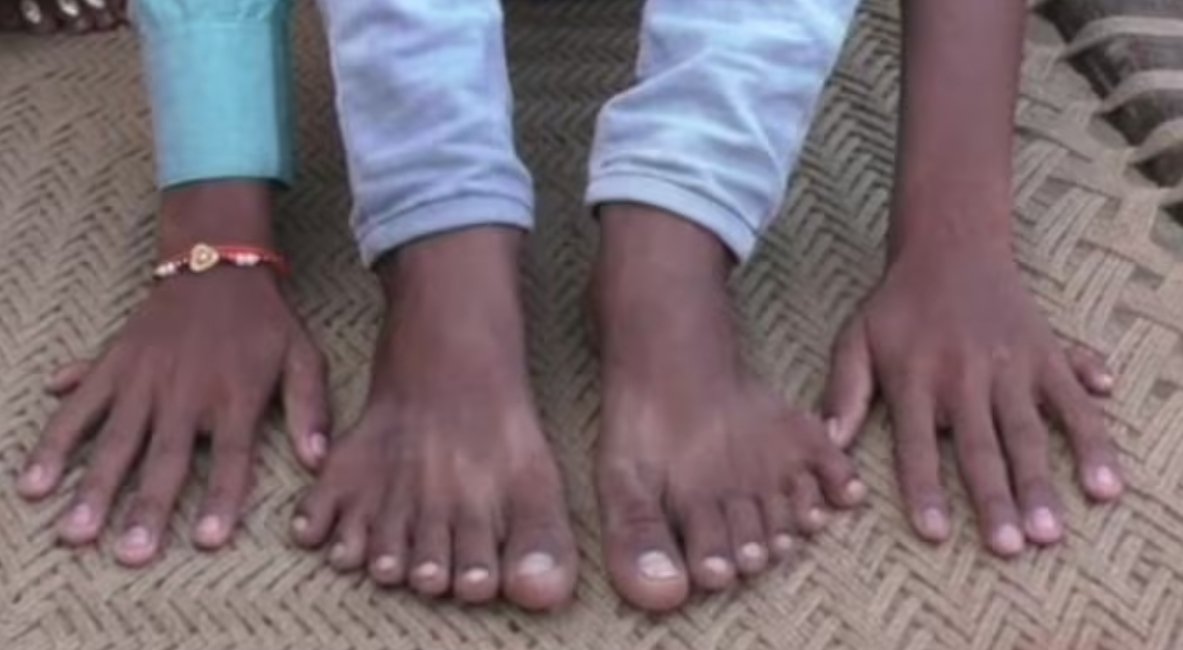 Пример полидактилии. Источник изображения: indiatoday.in. Фото.